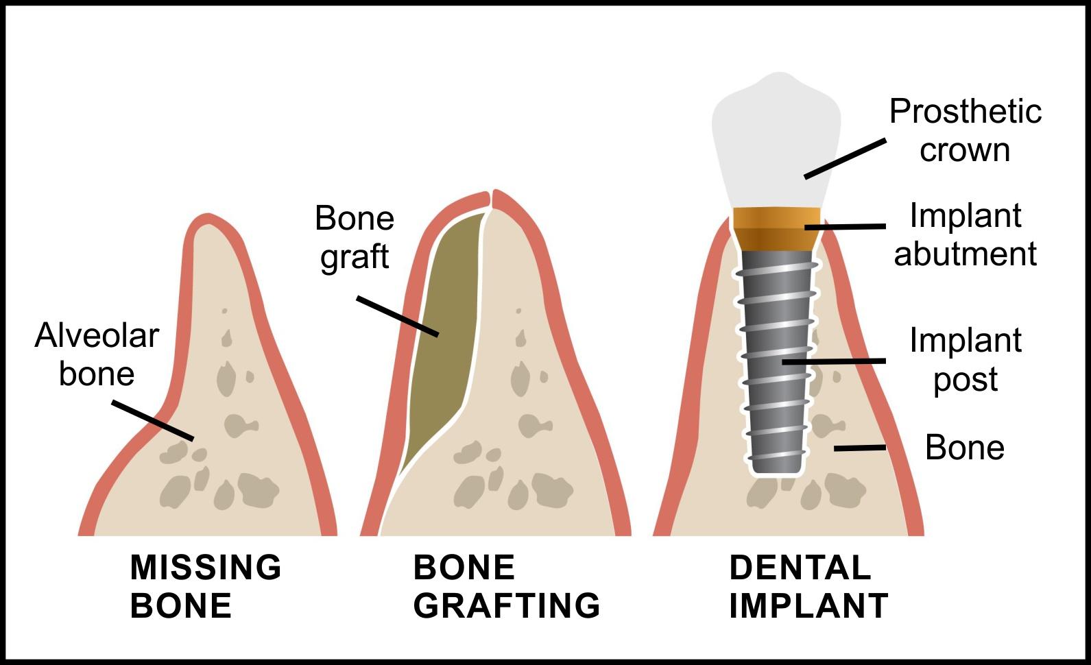 Advanced dental implant planning for bone loss