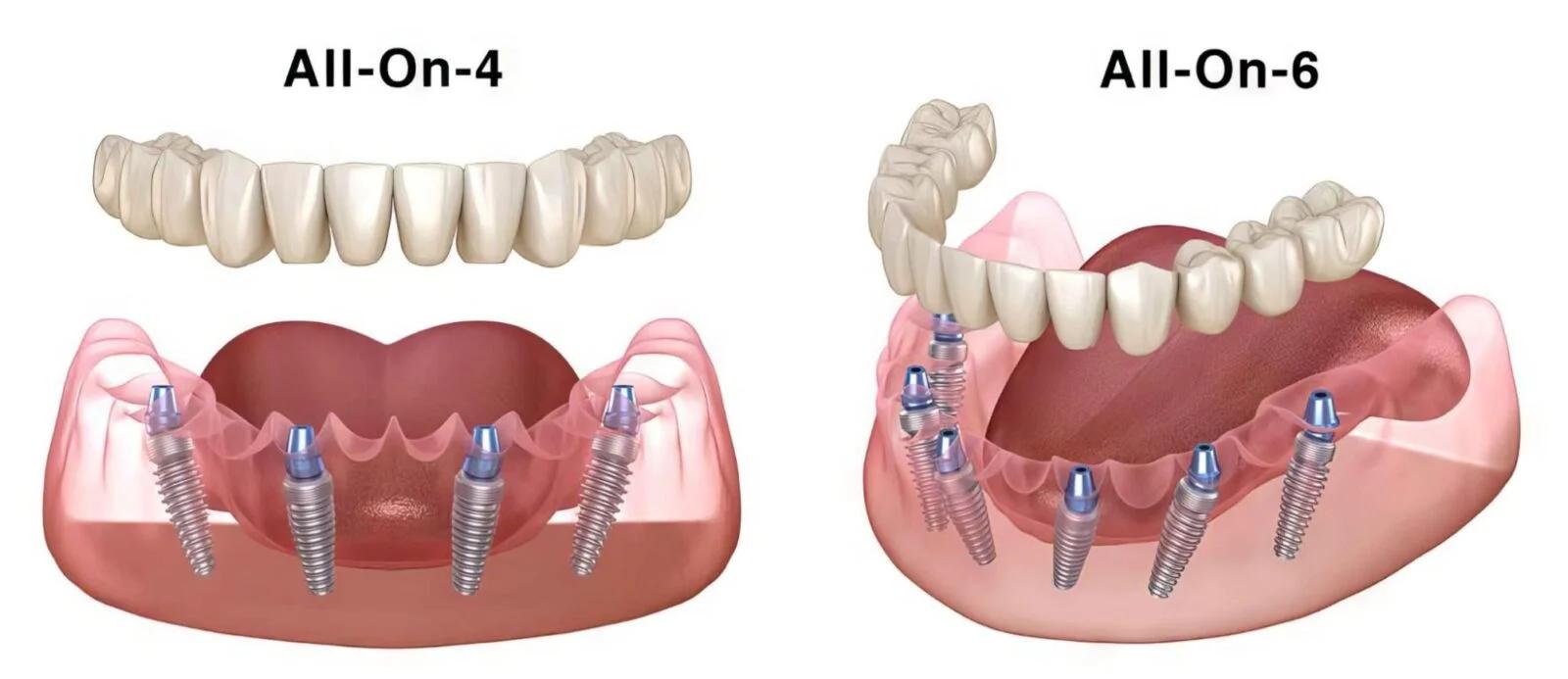 Full arch dental implants All-on-4 and All-on-6