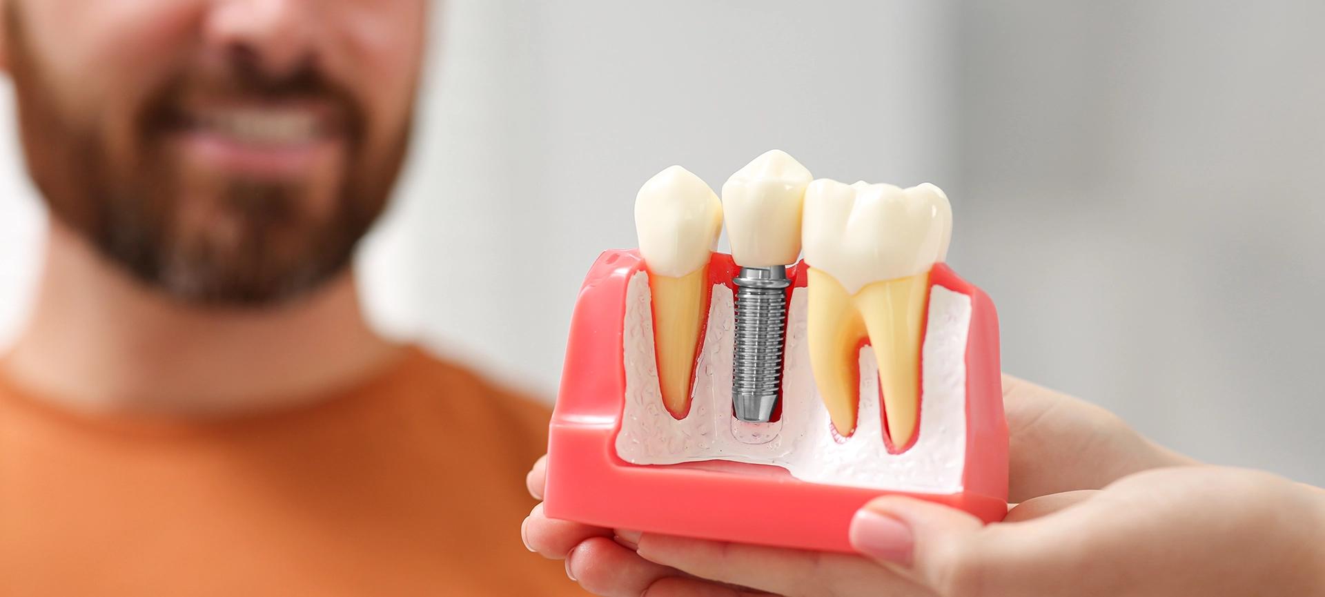 Dental implant treatment plan and temporary teeth