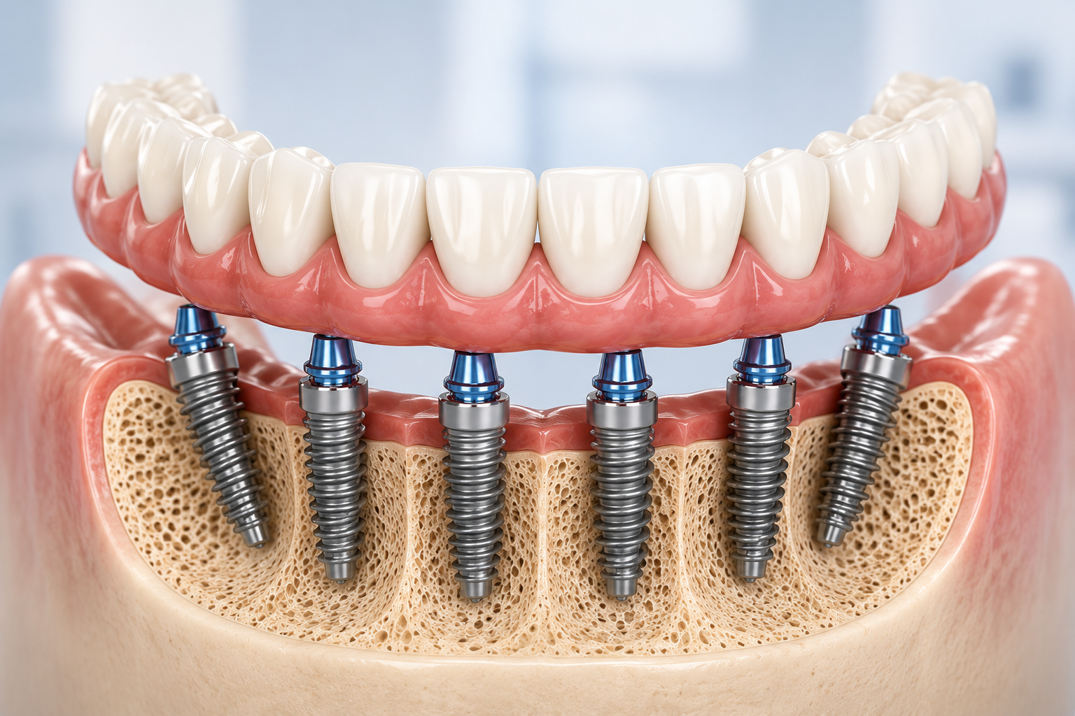 All-on-4 dental implant treatment